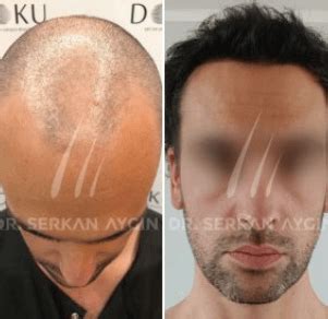 Dr. Serkan Aygin Review, Pricing, Before & After .